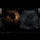 Liver metastasis, RFA, radiofrequency ablation of metastasis, CEUS: US - Ultrasound